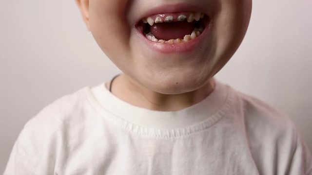 Close up shot of three years old baby boy smile with black decayed teeth. Health care, dental hygiene and childhood concept. Dental problems, caries. Isolated on neutral background