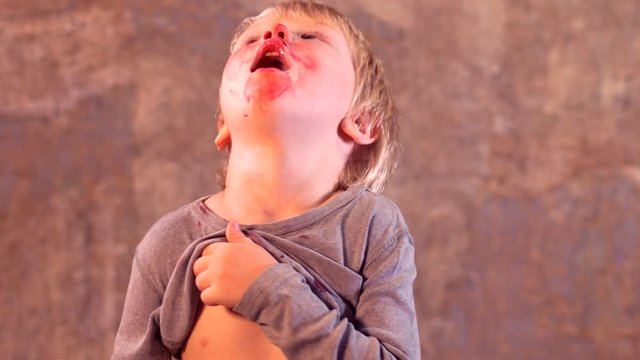 little fair-haired boy is smeared with blood. baby has weak vessels in nose bursting with pressure drops and changes in weather. Hemophilia disease. Blond child lifts his head to stop the bleeding