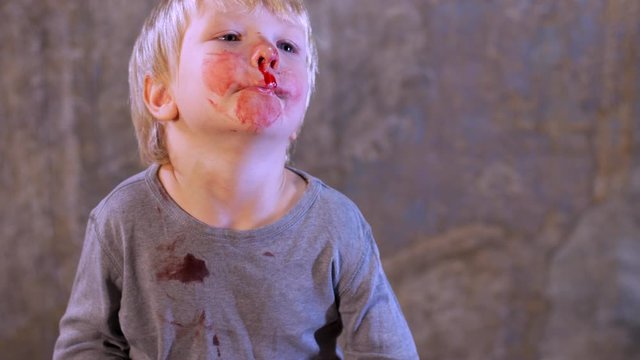 little fair-haired boy is smeared with blood. baby has weak vessels in nose bursting with pressure drops and changes in weather. Hemophilia disease. Blond child lifts his head to stop the bleeding