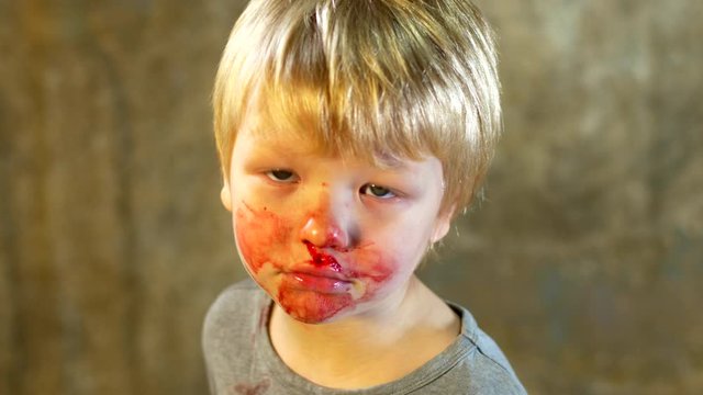 little fair-haired boy is smeared with blood. baby has weak vessels in nose bursting with pressure drops and changes in weather. Hemophilia disease. Blond child lifts his head to stop the bleeding