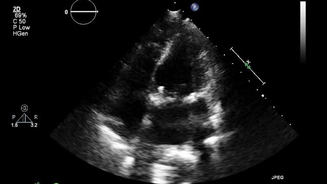 Video transesophageal examination of the heart in hd quality.