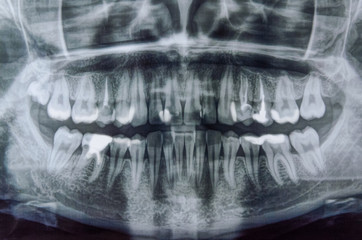 Panoramic x-ray scanning of human teeth. Women's the teeth with one tooth of wisdom