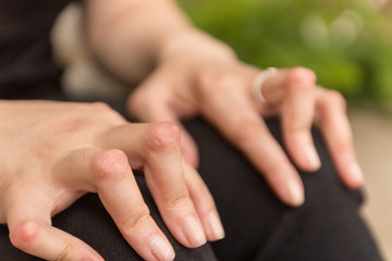 Young woman having rheumatoid arthritis takes a rest sitting on a bench. Hands and legs are...