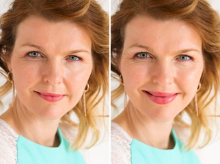 Woman's portrait before and after bigger lips enhancement procedure