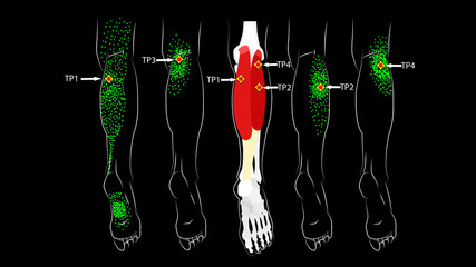 Calf muscle. Trigger points in the leg, reflected pain on the back of the thigh and in the foot. Leg pain