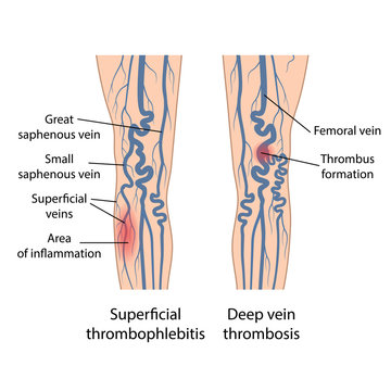 Superficial thrombophlebitis of legs. Deep vein thrombosis. Image of diseased legs. Vector illustration in flat style isolated on white background
