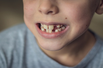 Closeup mounth of 8 years old kid, european boy showing temporary baby milk teeth missing, childhood and dentistry or medical concept, tooth care, natural light shot at daytime