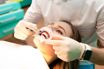 Patient with cheek retractor lies on the dental chair during the procedure  teeth whitening