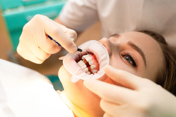 Close-up portrait woman patient with cheek retractor lies on the dental chair during the procedure 