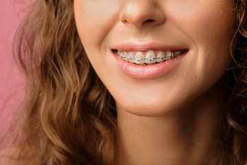 Closeup shot of pretty female smile with dental braces - obrazy, fototapety, plakaty