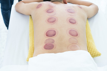 A man relax on bed while red round patch on back after finishing Cupping therapy to reduce Migraine,Pain relief. Thai person, Asian. People Getting the Cupping therapy in traditional chinese medicine