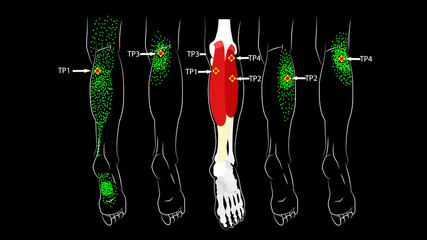 Calf muscle. Trigger points in the leg, reflected pain on the back of the thigh and in the foot. Leg pain