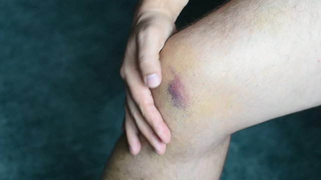 bruise, hematoma on the knee from injury and sprain