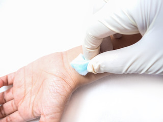 Nurse hand is cleaning the skin in the patient arm with Cotton wool moistened with alcohol. Process of cleaning the skin with normal alcohol at first