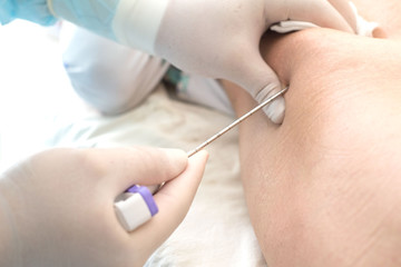 An oncologist, using a long needle, pierces a childs ilium to diagnose bone marrow for leukemia,...