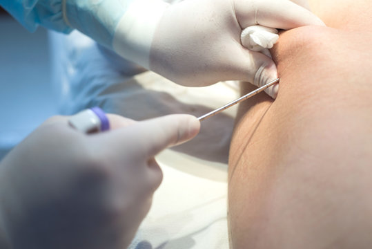 An oncologist, using a long needle, pierces a childs ilium to diagnose bone marrow for leukemia, Ewings sarcoma