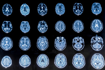 Series of CAT Scans showing the human head. Examination, treatment. Tamography, MRI, X-ray