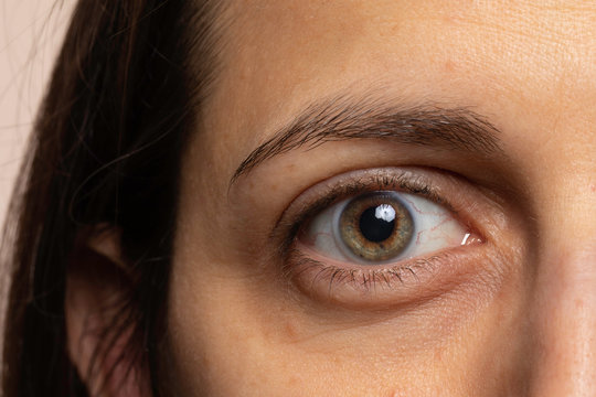 Tired woman with eye bags close up view