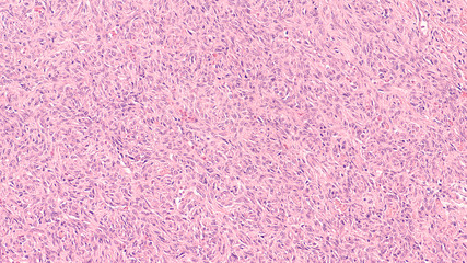 Fototapeta premium Photomicrograph of a solitary fibrous tumor, a type of soft tissue tumor which typically occur in the pleura but may arise in other locations. 