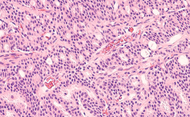 Prostate Cancer Oncology Awareness: Photomicrograph of core biopsy of prostate gland showing histology of adenocarcinoma in patient with elevated PSA. 