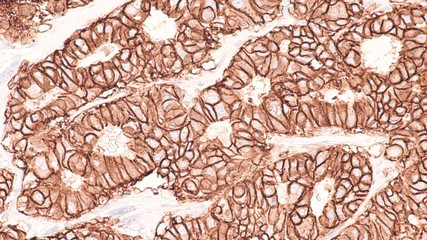 Photomicrograph of immunohistochemistry for HER2,  showing positive cell membrane staining in this...