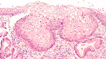 Photomicrograph (microscopic image) of cervix biopsy showing low grade squamous intraepithelial lesion (LSIL, mild dysplasia, CIN 1) due to human papilloma virus (HPV).  HPV vaccine is now available. - obrazy, fototapety, plakaty