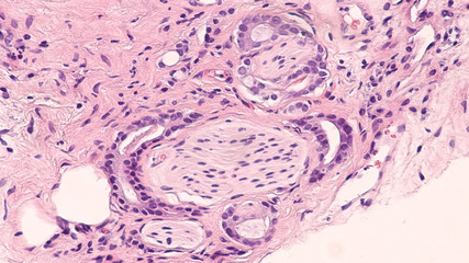 Prostate Cancer Core Biopsy Histology (Pathology): Adenocarcinoma of the prostate with 