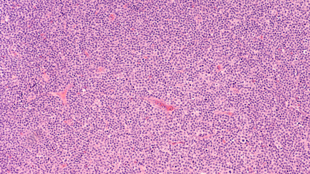 Lymphoma awareness: photomicrograph of a small lymphocytic lymphoma (SLL) a type of non-Hodgkin lymphoma.