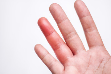 Woman palm right hand with red swelling from a bee sting on sister finger , inflammation allergy on...