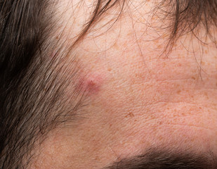 Fototapeta premium pigmentation on the skin of the face