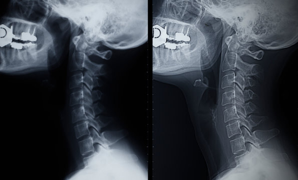 Neck X-ray detail