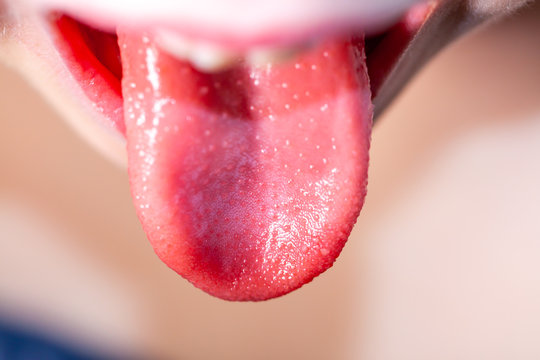 Tongue Of A Child With Scarlet Fever - Strawberry Tongue