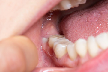 Wisdom tooth in open mouth close up - obrazy, fototapety, plakaty