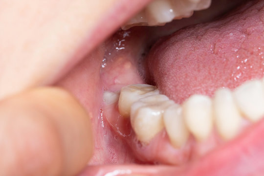Wisdom tooth in open mouth close up