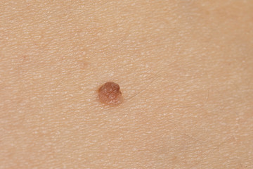 Verruca, birthmark with hair close up