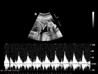 Ultrasound screen with fetal echocardiography.