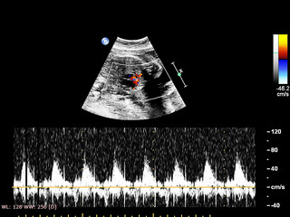 Ultrasound screen with fetal echocardiography.
