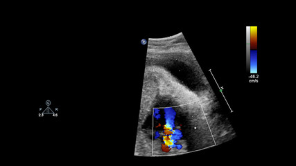 Ultrasound screen with fetal echocardiography.