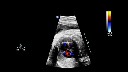 Ultrasound screen with fetal echocardiography.