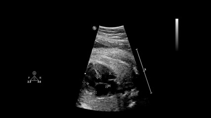 Ultrasound screen with fetal echocardiography.