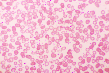 Essential thrombocytosis blood smear, present abnormal high platelet, analyze by microscope