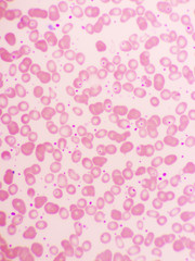 Essential thrombocytosis blood smear, present abnormal high platelet, analyze by microscope