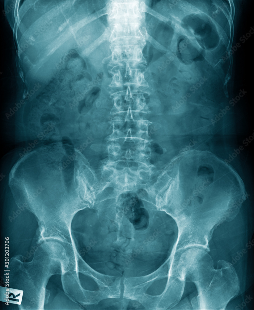 Poster lumbar spondylosis x-ray image