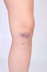 Bruise on a knee of a small child on a gray background