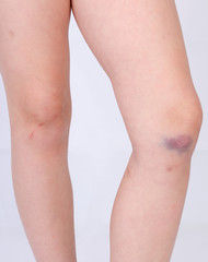 Bruise on a knee of a small child on a gray background