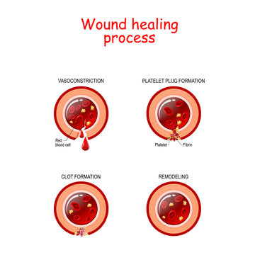Phases of the wound healing process. poster with capillary, red blood cells, fibrin protein and platelets that healing wound.