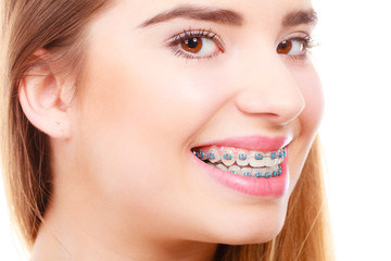 Woman showing her teeth with braces