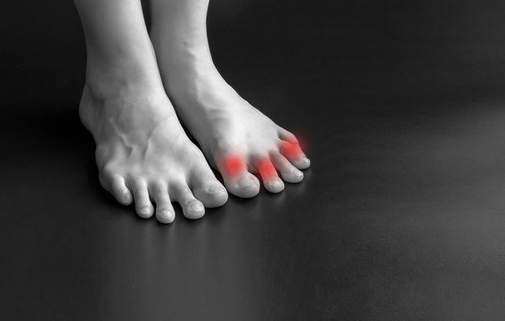 Toes close-up, taped. Pain from rubbing calluses shoes. Close-up, dark background.
