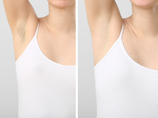 Young woman before and after armpits depilation on light background