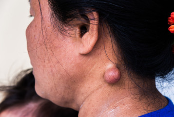 Sebaceous cyst on the neck woman form out of sebaceous gland the oil called sebum and skin treatment of laser or punch biopsy excision.Medical concepts. - obrazy, fototapety, plakaty